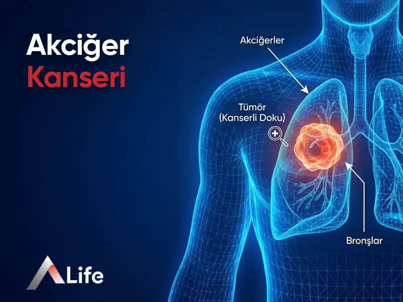 Akciğer Kanseri Tedavisi​ | Akciğer Kanseri Aşısı